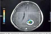 The effects of voxel localization and time of echo on the diagnostic accuracy of cystic brain tumors in 3 tesla magnetic resonance spectroscopy